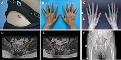 A case report of multicentric reticulohistiocytosis with atypical cutaneous presentation